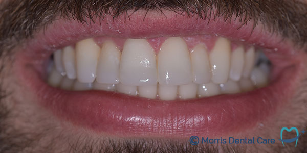 After the treatment which involved clear aligners, composite bonding and teeth whitening our patient was delighted with the confidence having a balanced and whiter smile. 